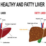 9 Useful Functions of the Liver and Common Type of Fatty Liver – Causes, Symptoms & Care